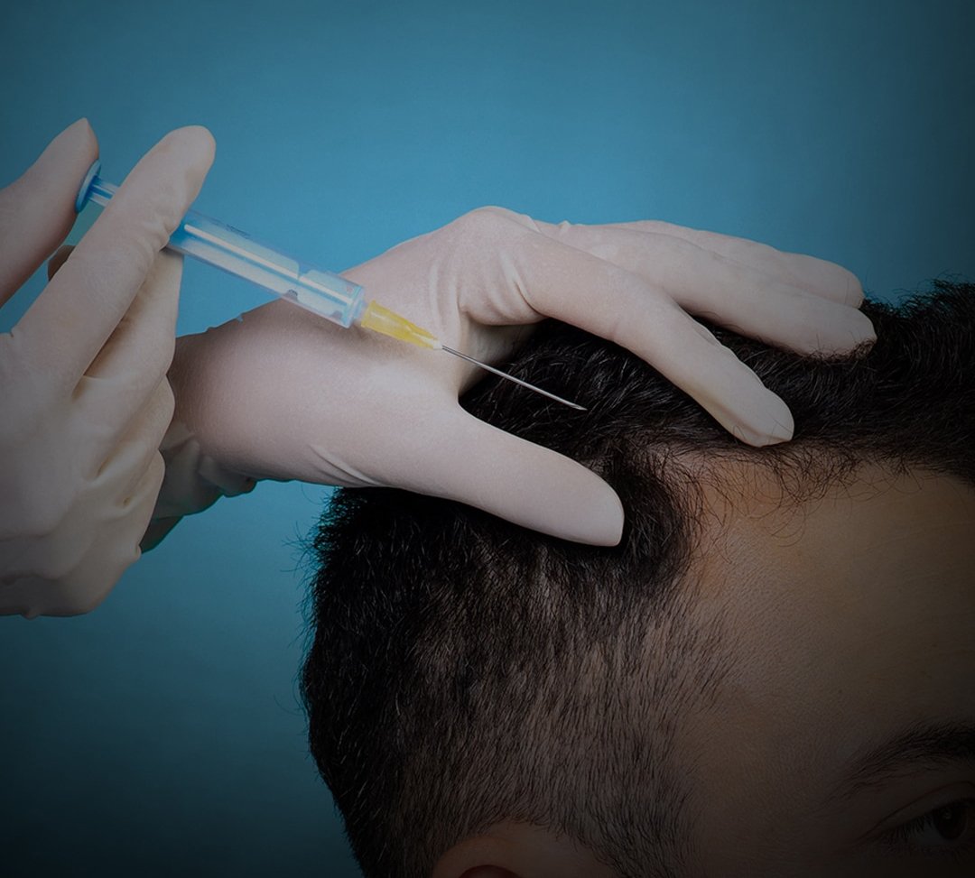 Hair Transplant Clinic in Ahmedabad