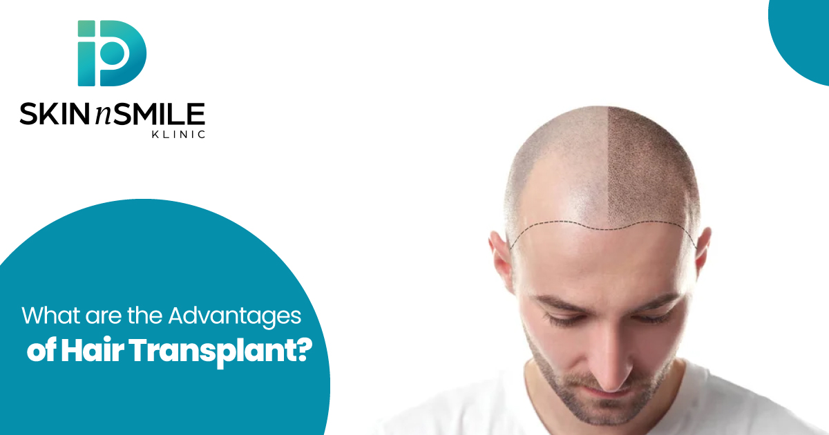 Advantages of Hair Transplant