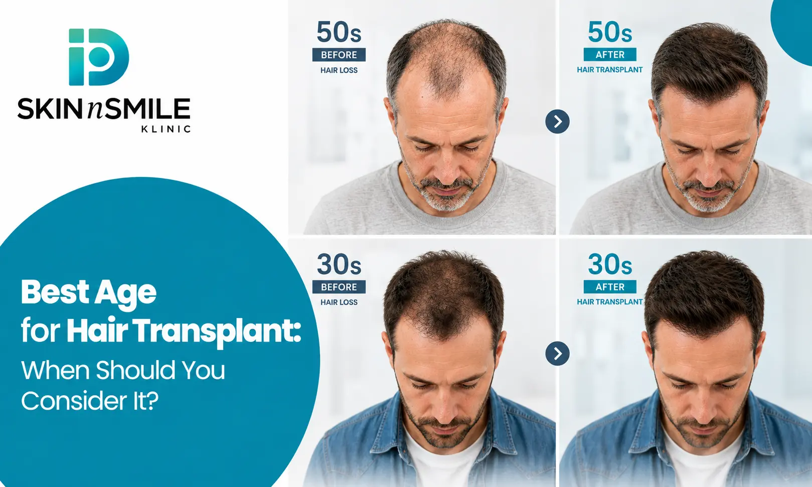 Best age for hair transplant