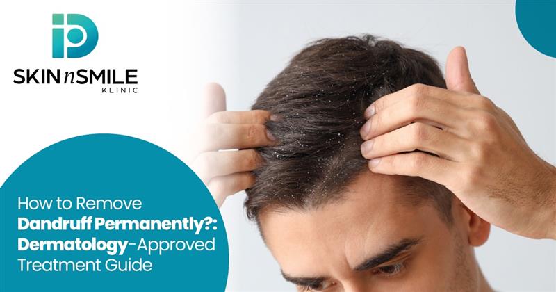 How to Remove Dandruff Permanently?
