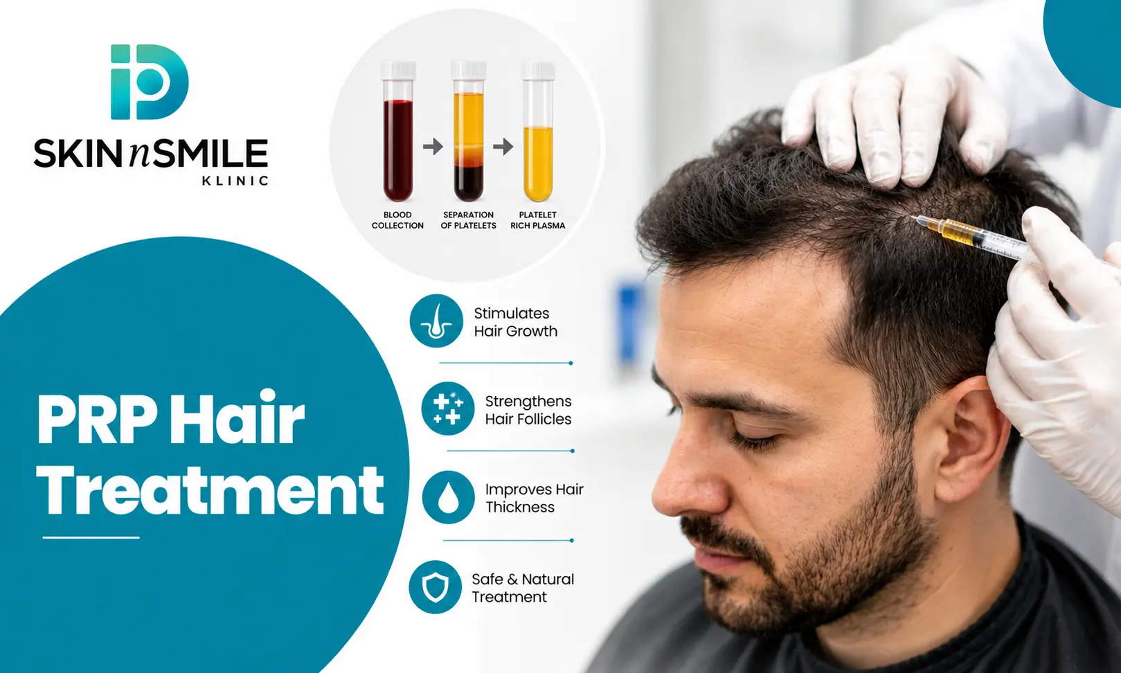 PRP hair treatment in Ahmedabad