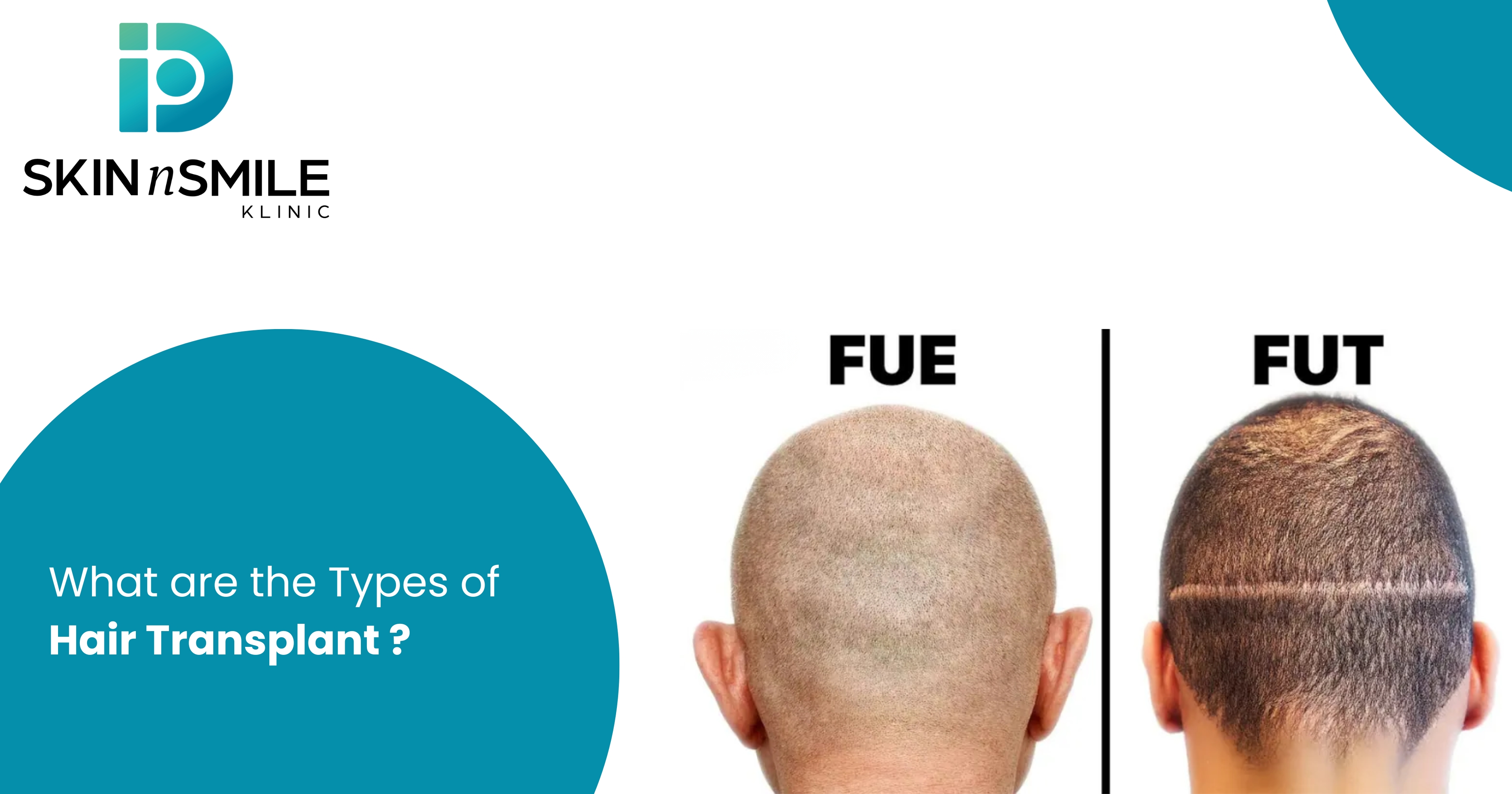 What are the Types of Hair Transplant?