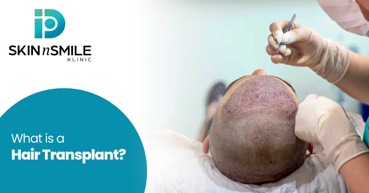 PRP Hair Treatment in Ahmedabad
