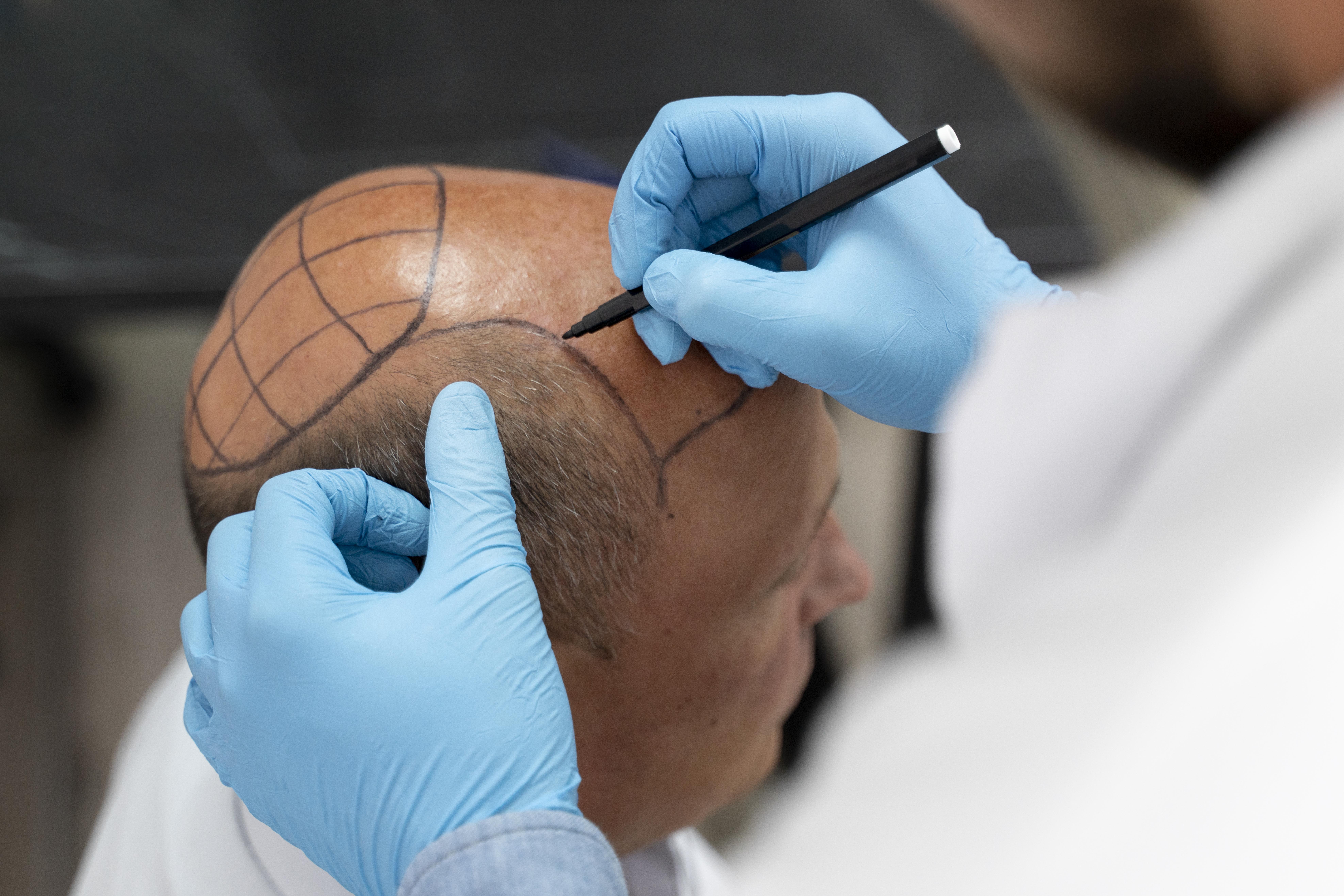 dhi hair transplant dhi hair transplant