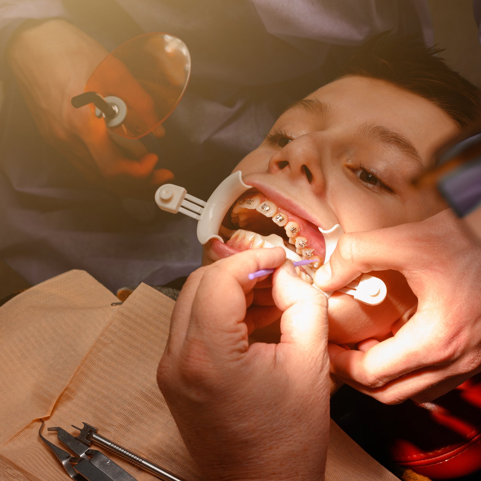 Dental Implants in Ahmedabad